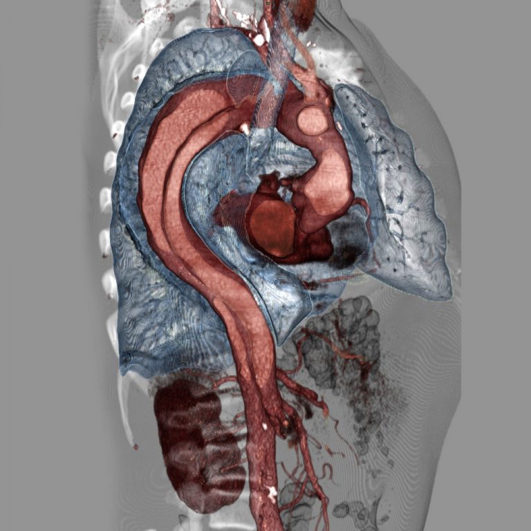 Acute Aortic SyndromesAcute Aortic Syndromes | RECAPEM RecapEM