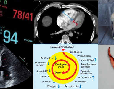 Pulmonary embolism