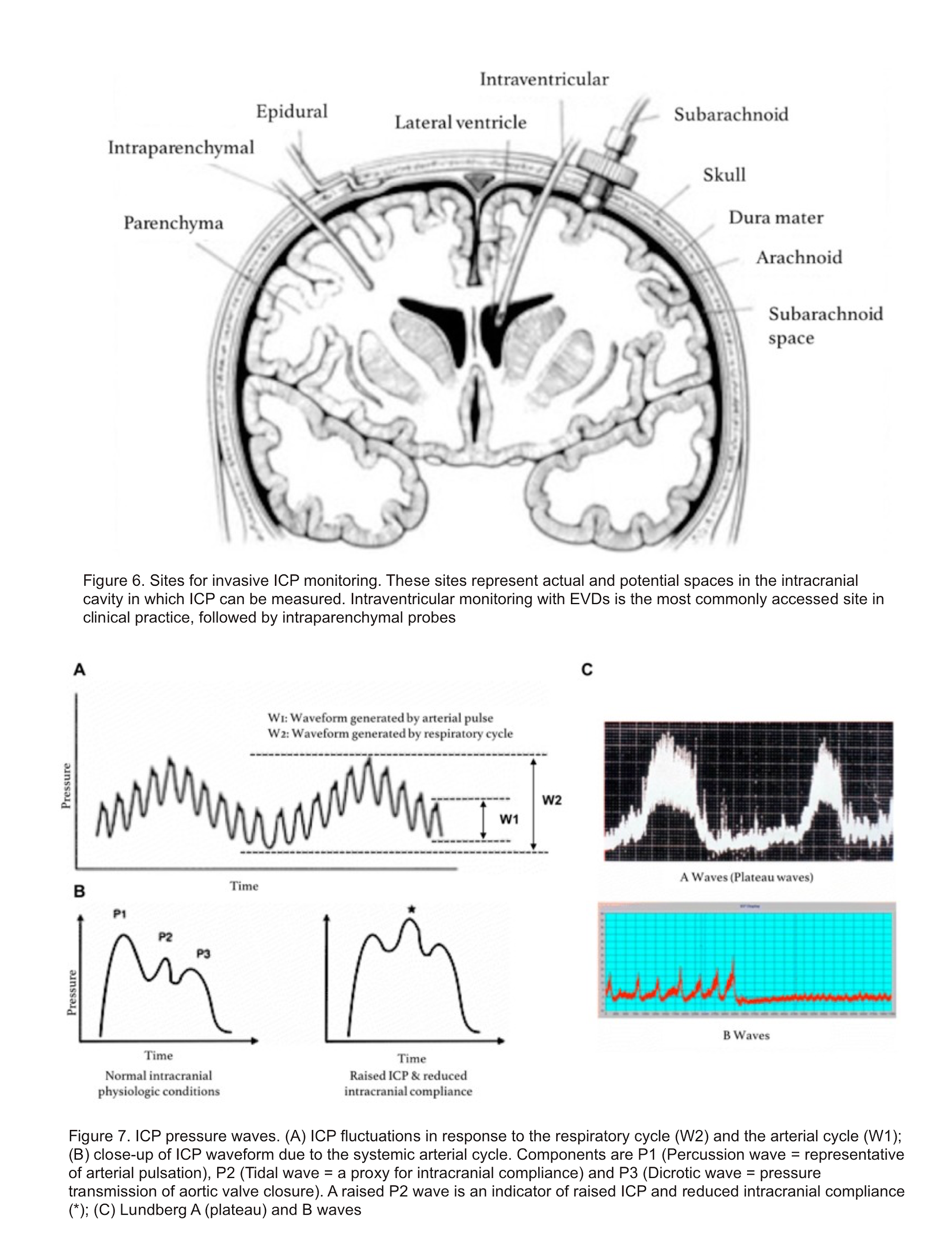 Icp Waveforms Abc Waves