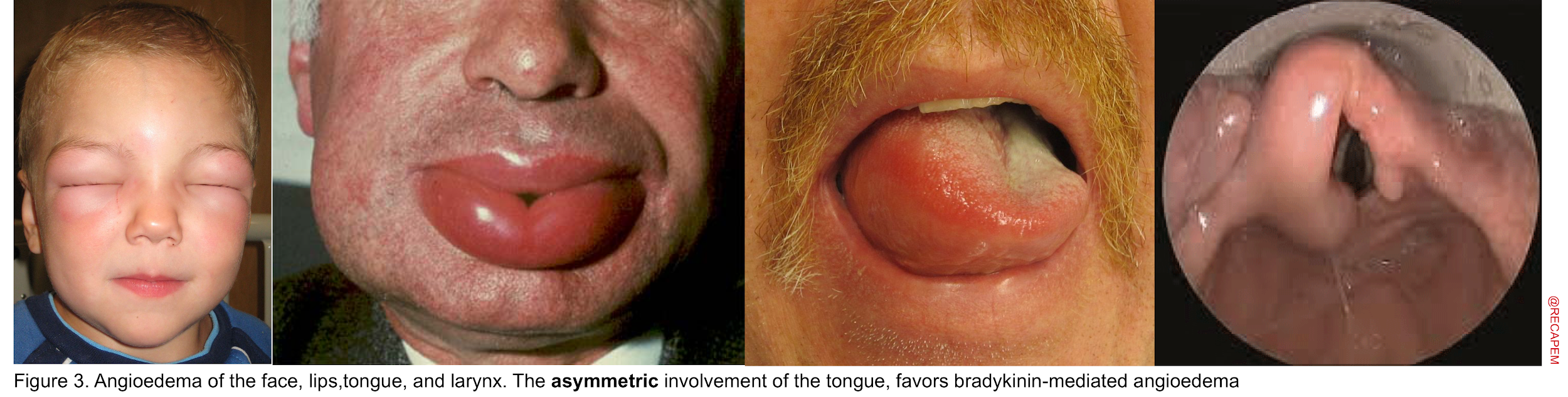 angioedema lips