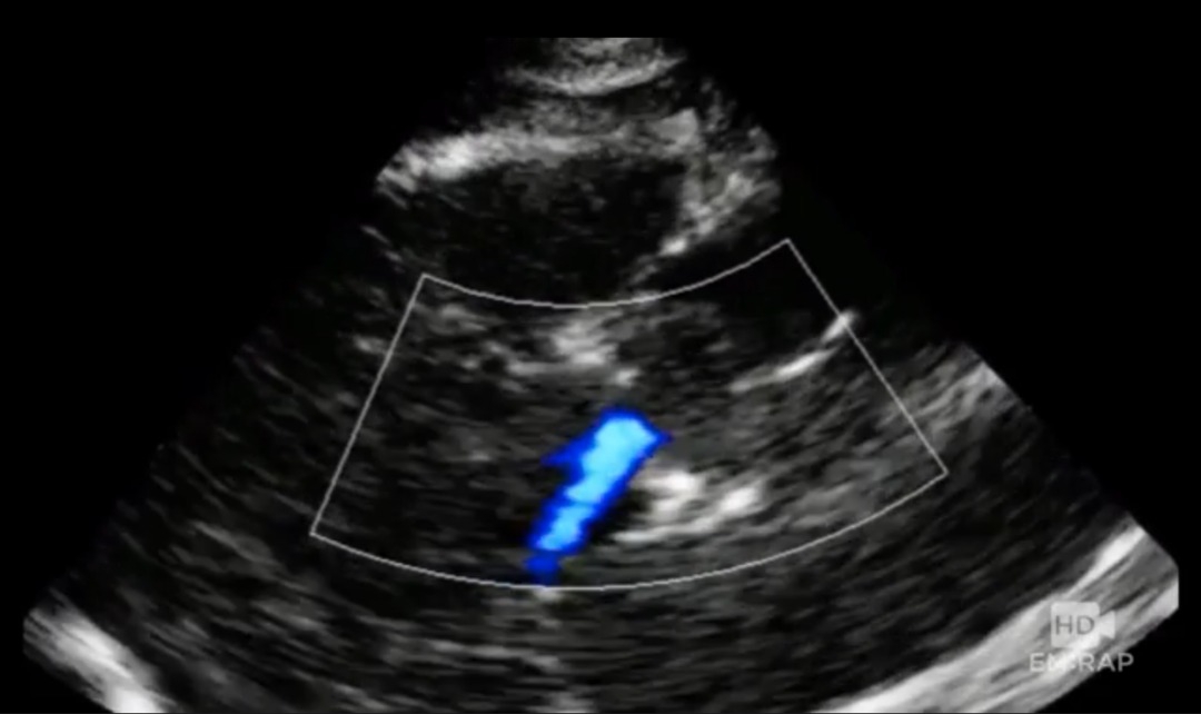 Ultrasound Of Aortic Dissection Recapem
