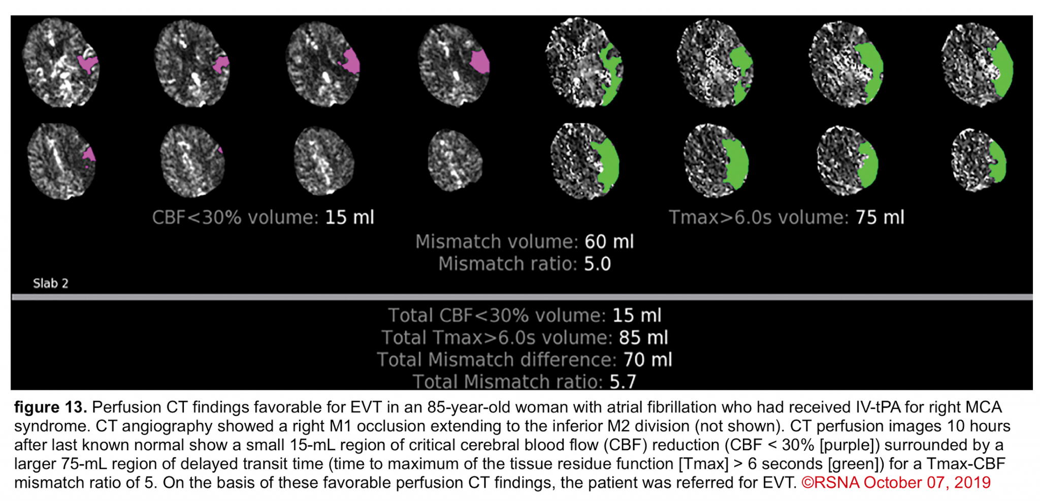 ischemic stroke unspecified icd 10