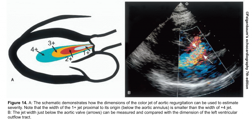 Valvular Emergencies Part 2: Diagnosis And Management Of Severe Aortic ...