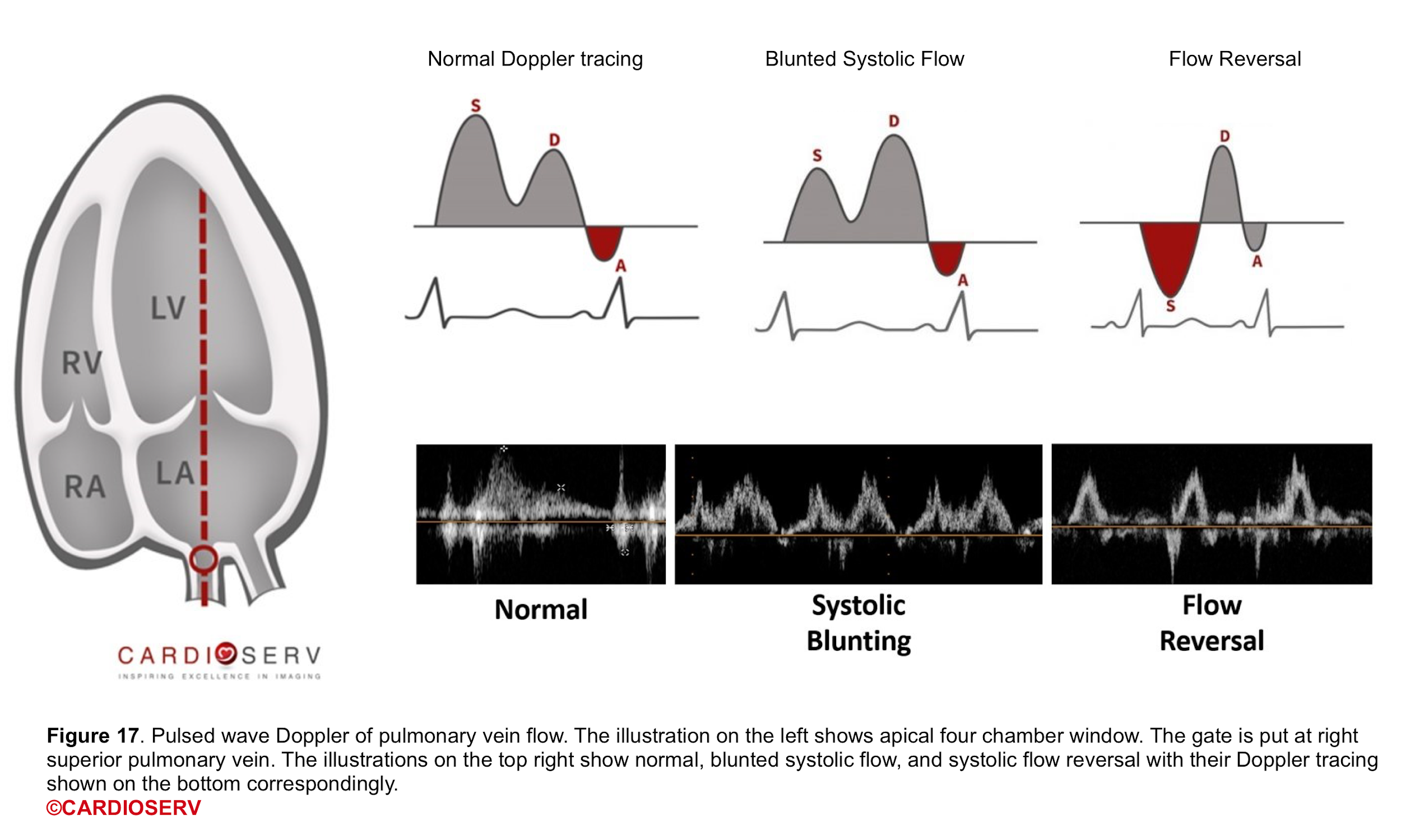 5 Steps to Identify Diastolic Dysfunction in Echo Cardioserv