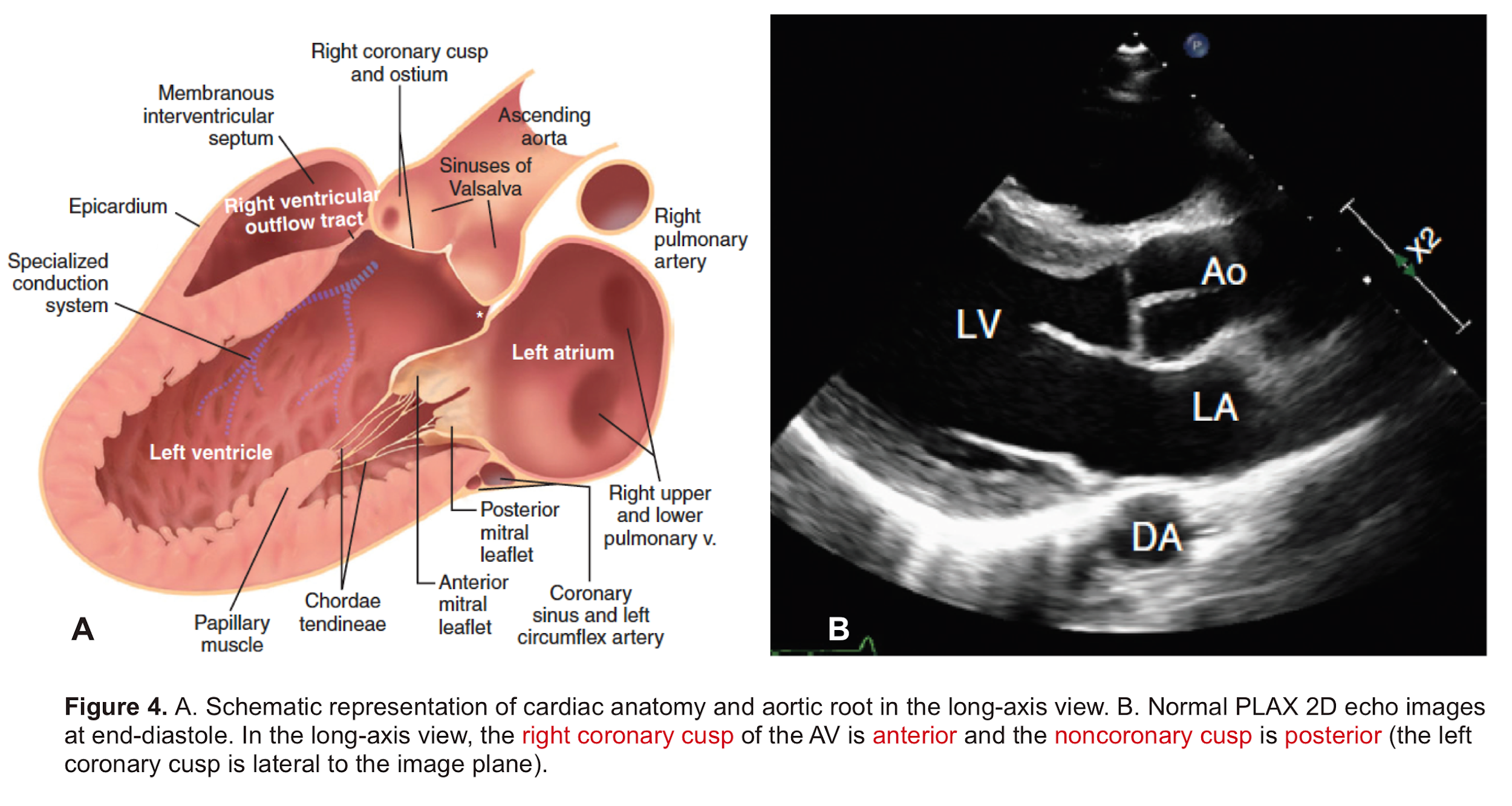 echo view of aortic leaflet