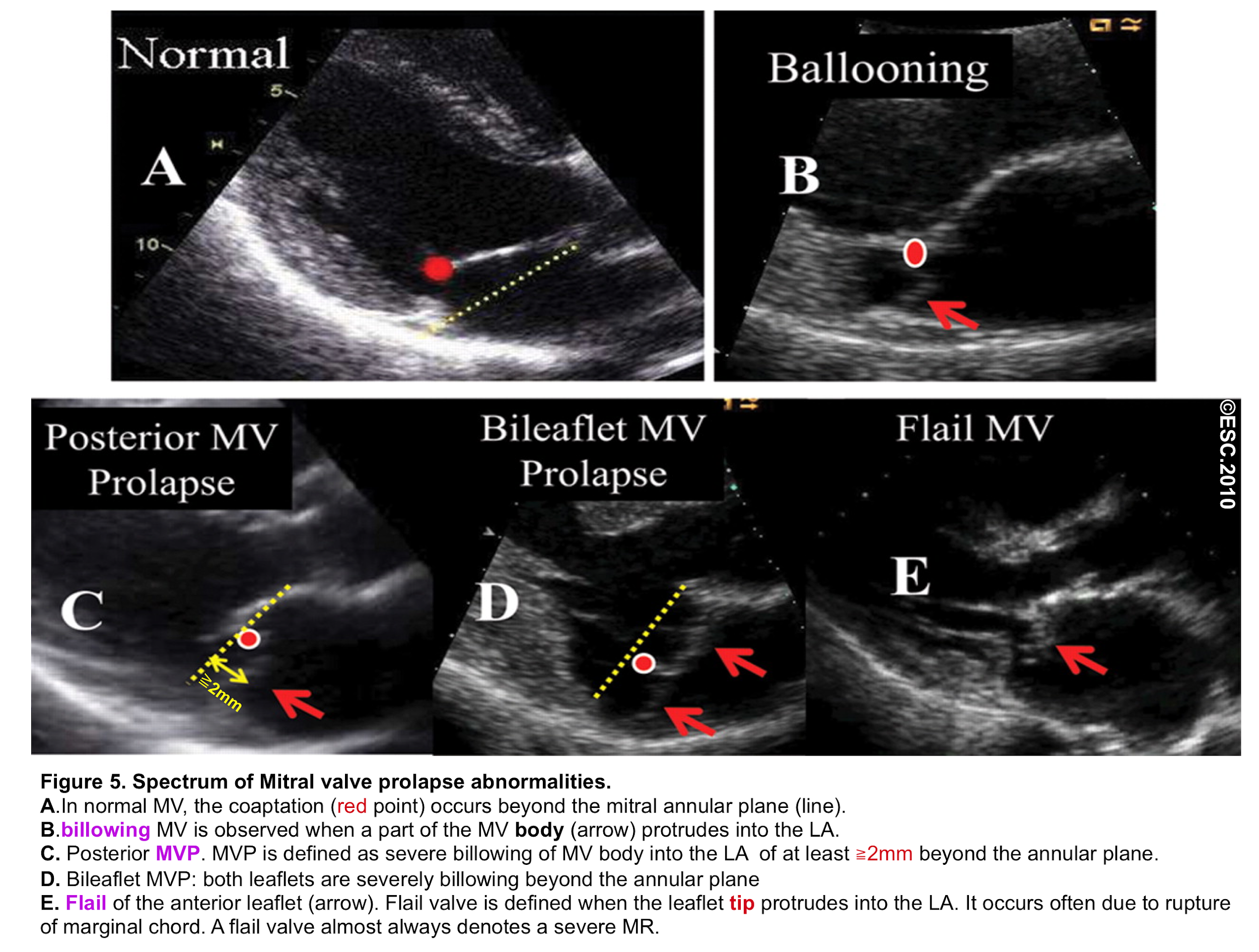 Пролапс клапана форум. Пролапс митрального клапана на ЭХОКГ. Mitral Valve Echo. Пролапс митрального клапана 1 степени на ЭХОКГ.