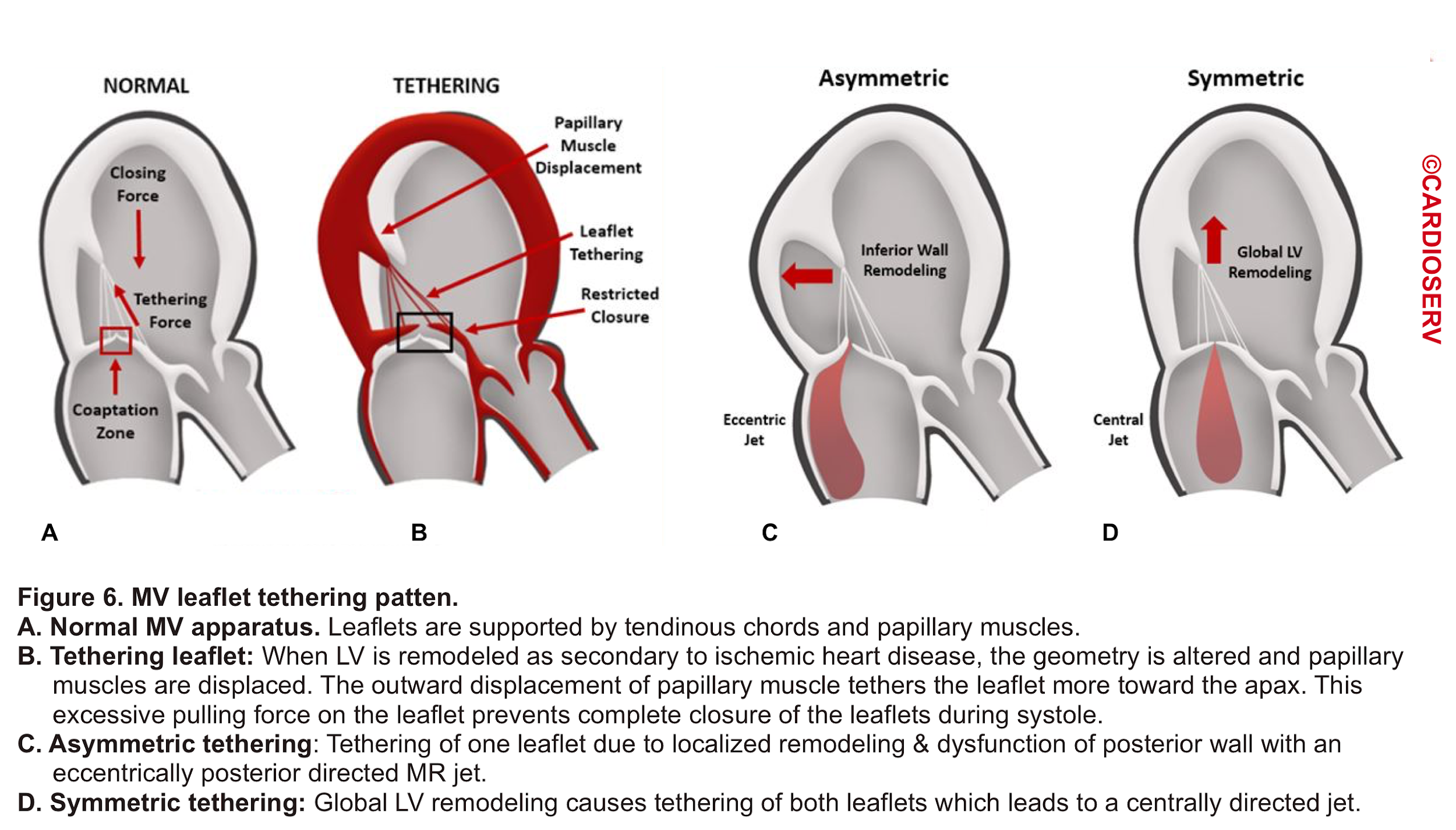 valvular-emergencies-part-1-diagnosis-and-management-of-severe-mitral