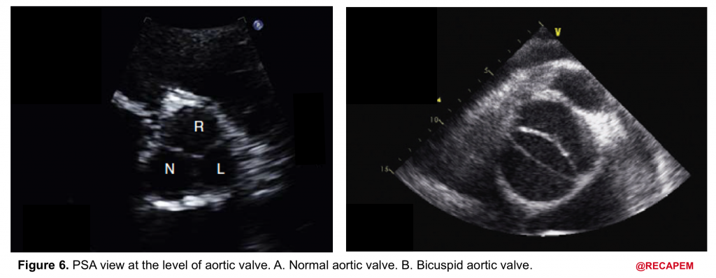 Valvular Emergencies Part 2: Diagnosis and Management of Severe Aortic ...