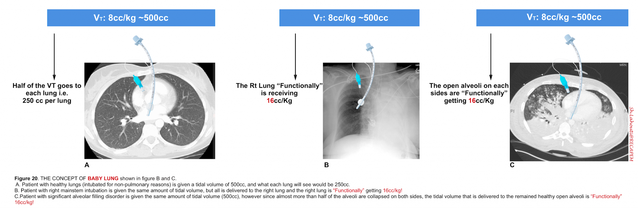 Mechanical Ventilation From Bench to The Bedside Review RECAPEM