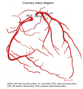 acute myocardial infarction