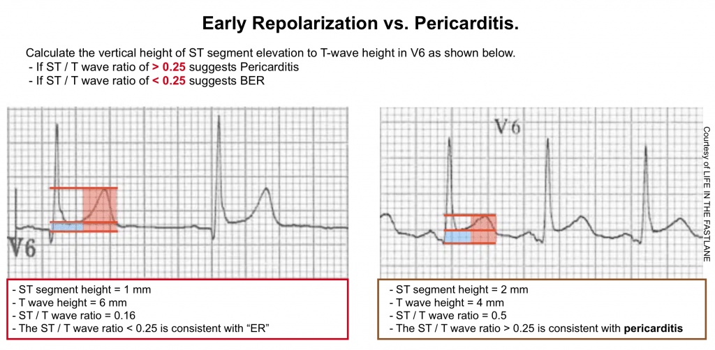 acute myocardial infarction