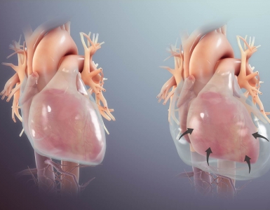 Cardiac Tamponade