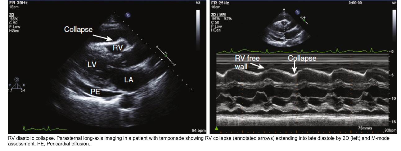 right ventricular collapse in diastole in tamponade