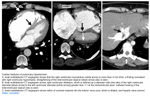 Pulmonary hypertension CT