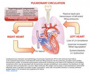 pulmonary hypertension in left heart disease