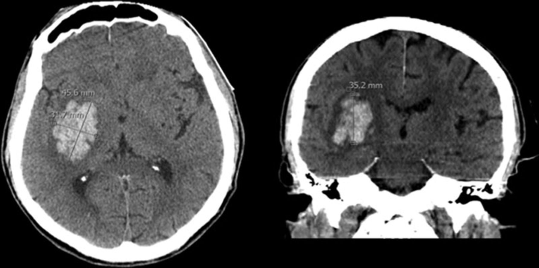 Magnetic resonance imaging. Large intracranial hemorrhage with moderate