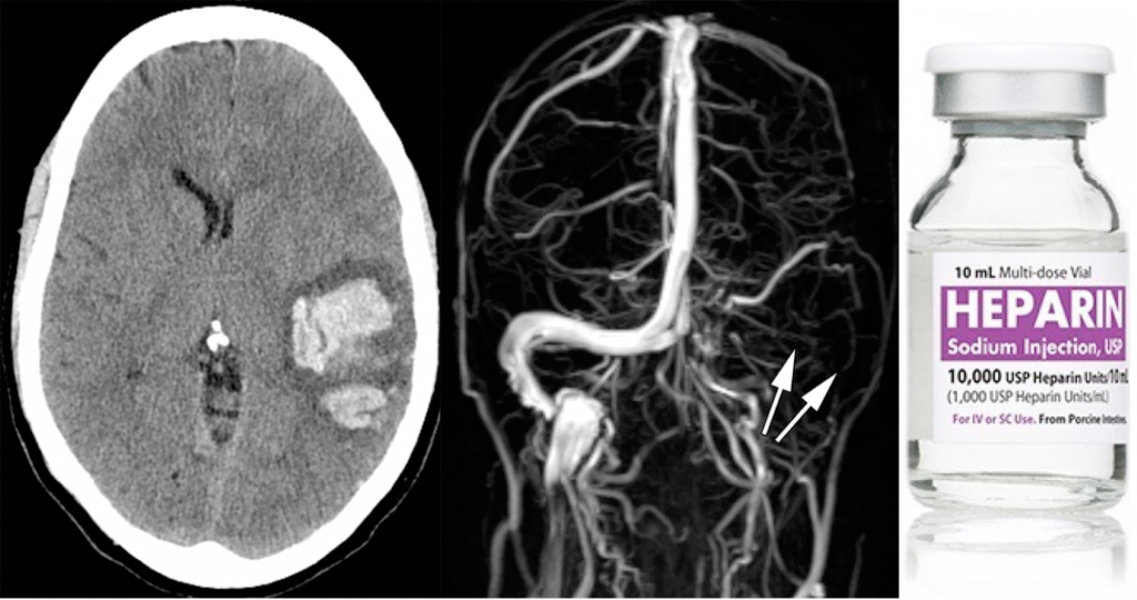 Venous vascular territories of the lateral cerebral cortex (illustration), Radiology Case