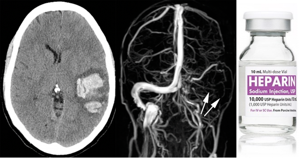 Subarachnoid Hemorrhage (SAH) - EMCrit Project