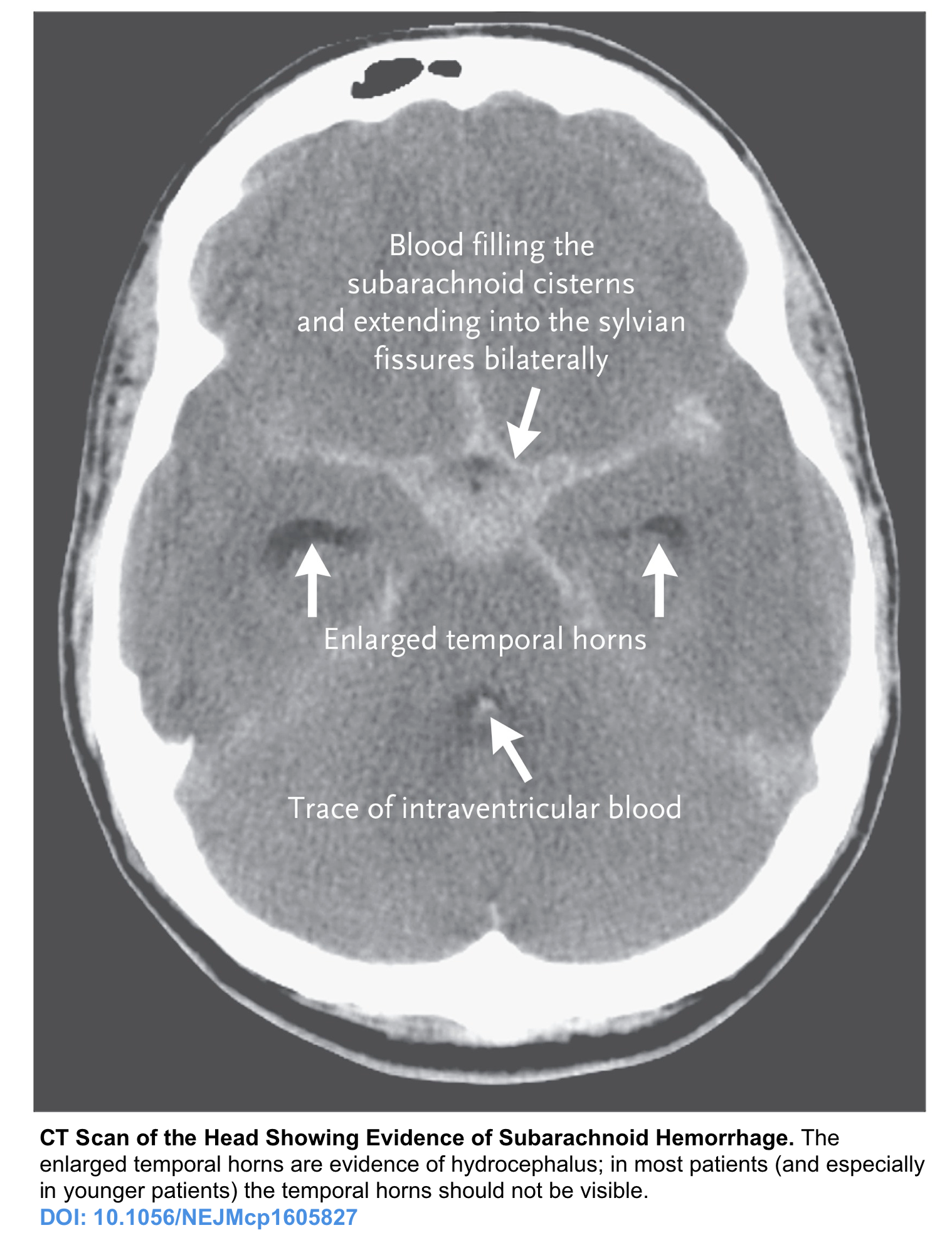 SAH Management Algorithm – Peripheral Brain