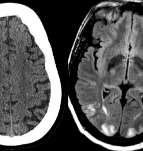 reversible cerebral vasoconstriction and posterior reversible encephalopathy syndrome