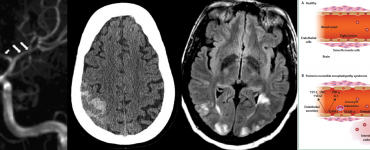 reversible cerebral vasoconstriction and posterior reversible encephalopathy syndrome