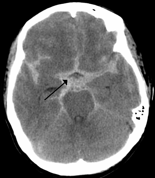 Ottawa SAH Rule – Peripheral Brain