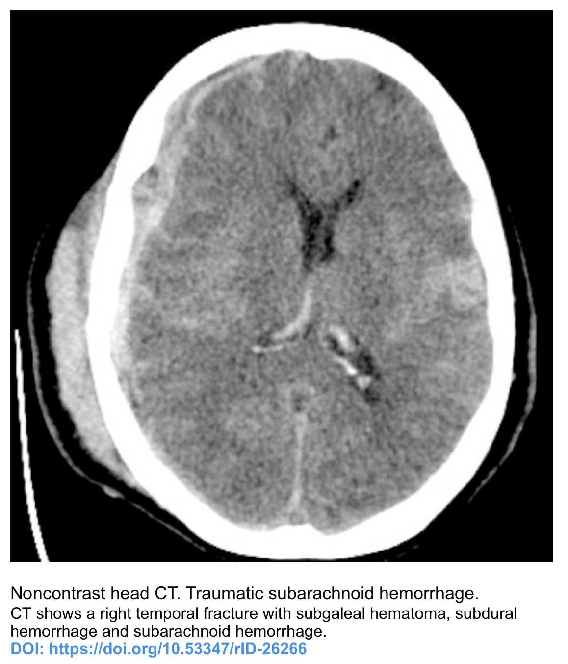 Imaging Evaluation of SAH and Aneurysm