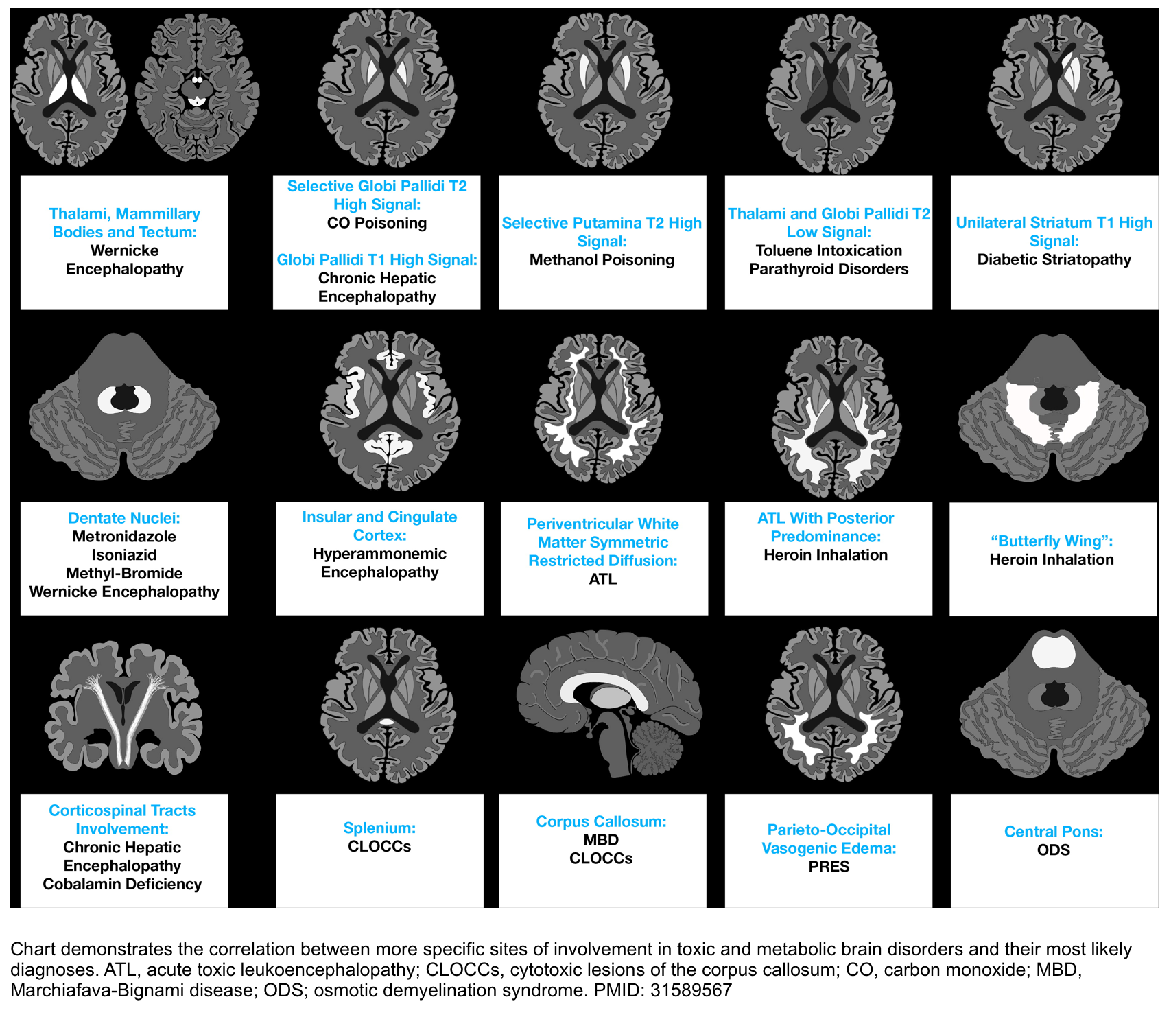toxic and metabolic brain disorder MRI