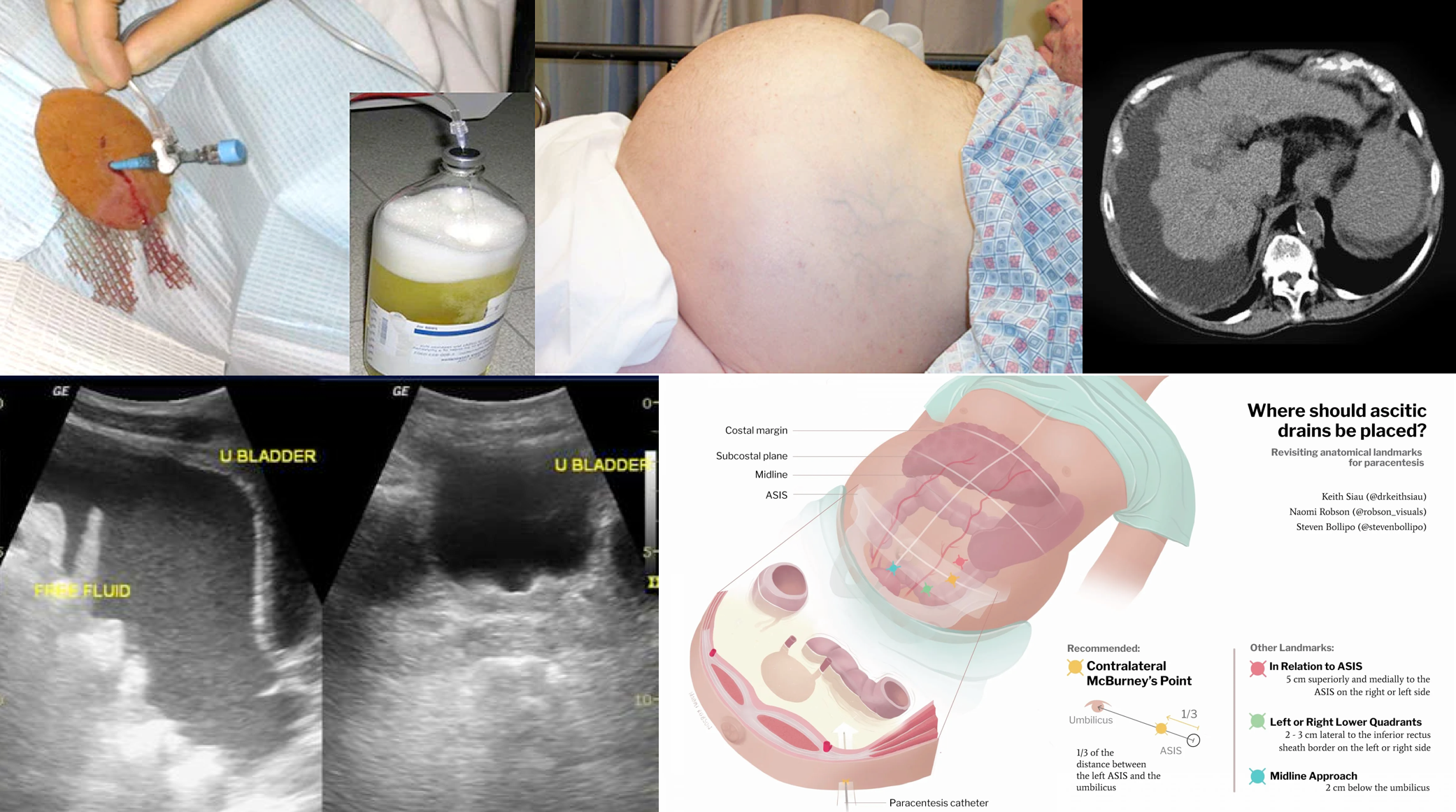 Hemorrhagic Ascites, Belly-Blood: The cause may be endometriosis!