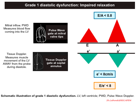 How to Measure and Grade Diastolic Dysfunction using Echocardiography -  POCUS 101