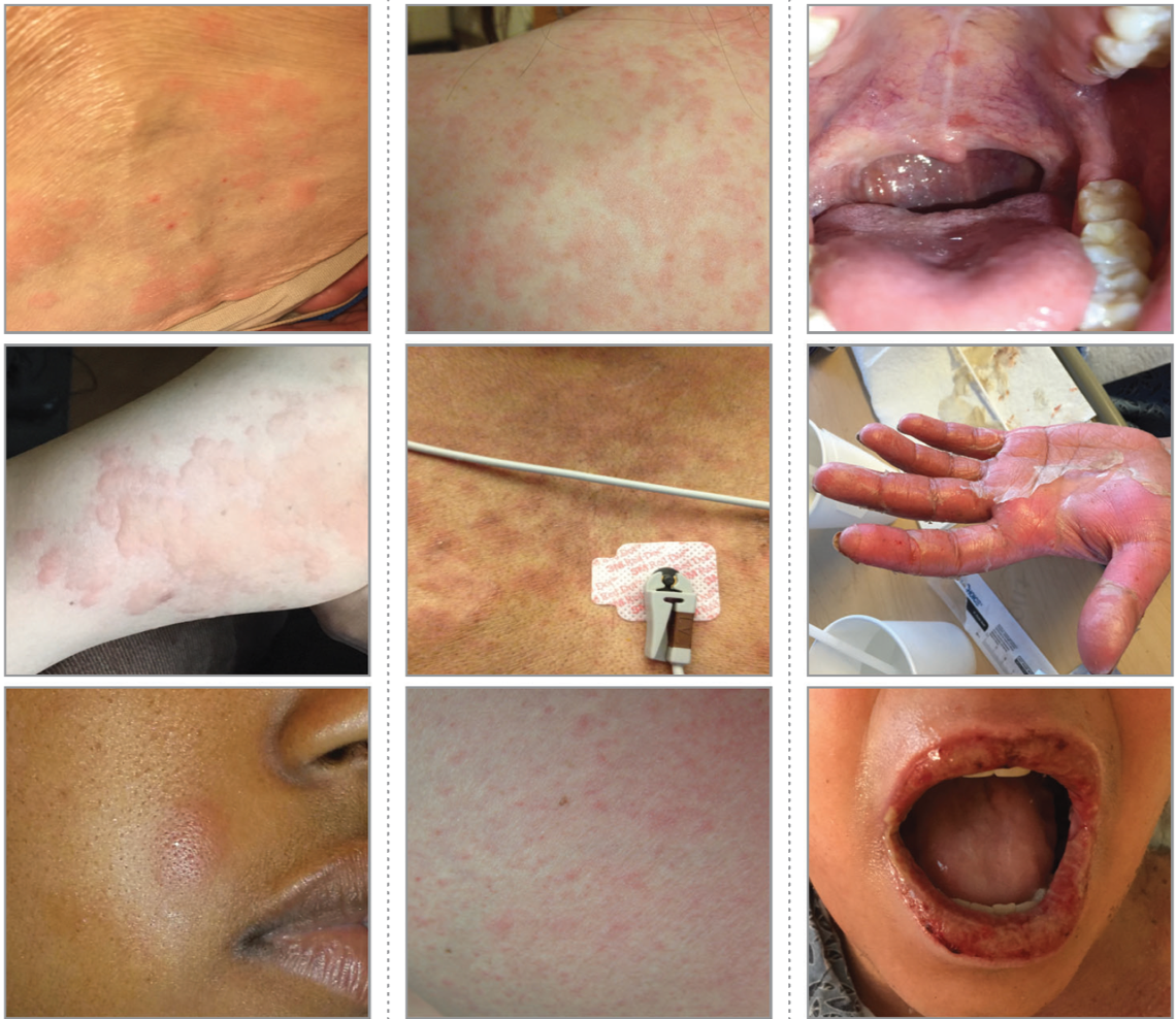 Allergy Severe Factory Buy Www pinnaxis