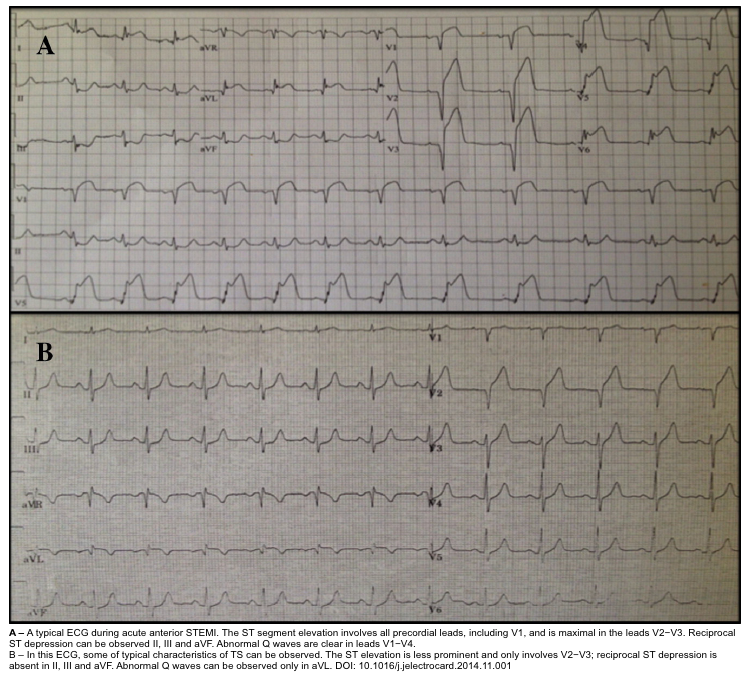 Takotsubo Syndrome: A Comprehensive Review