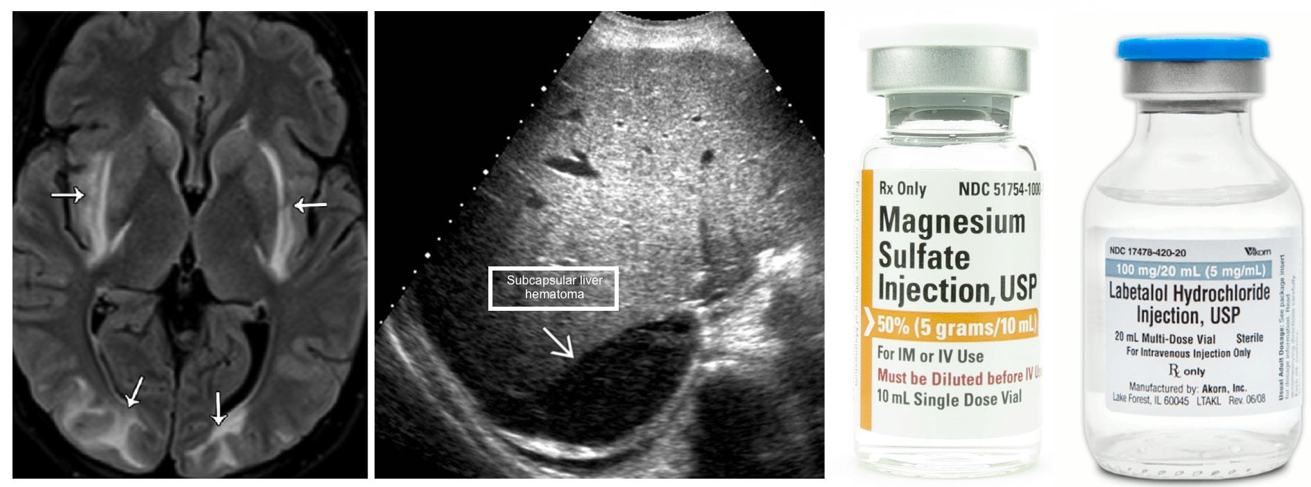 Beta-Adrenergic Blocking Agent Labetalol HCl 5 mg / mL Intravenous  Injection Multiple Dose Vial 40 mL