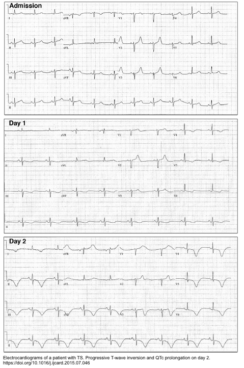 Takotsubo Syndrome: A Comprehensive Review