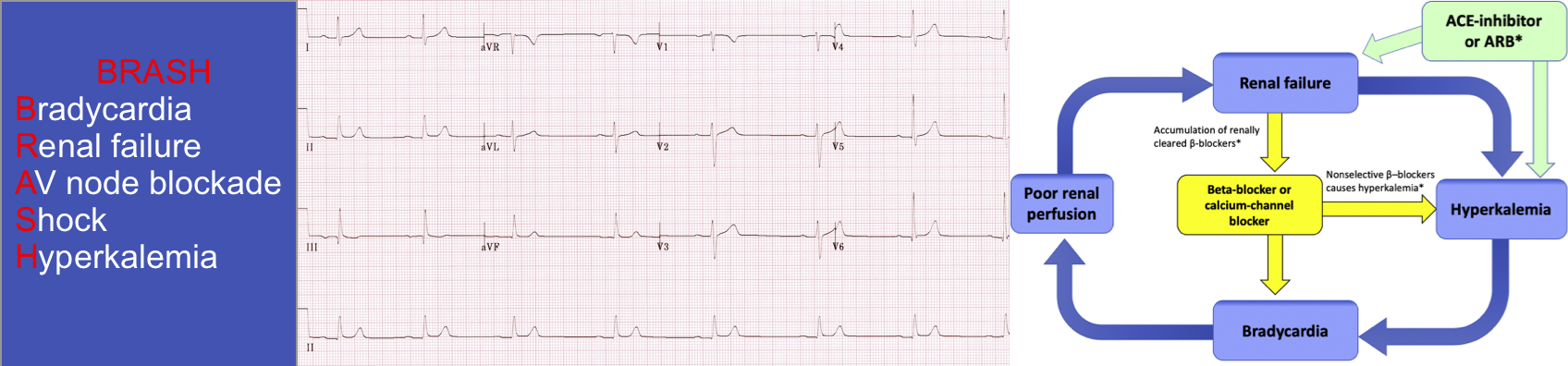 BRASH syndrome 