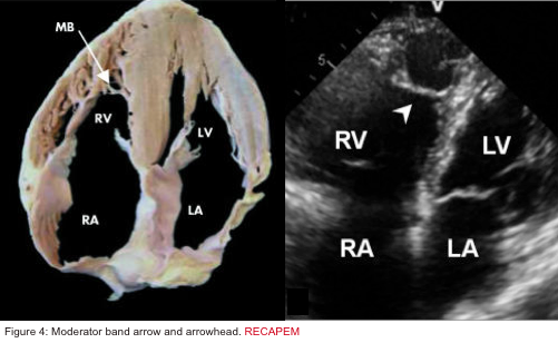 Acute Right Heart Failure: Principles of Diagnosis and Management In The ED  Revisited.