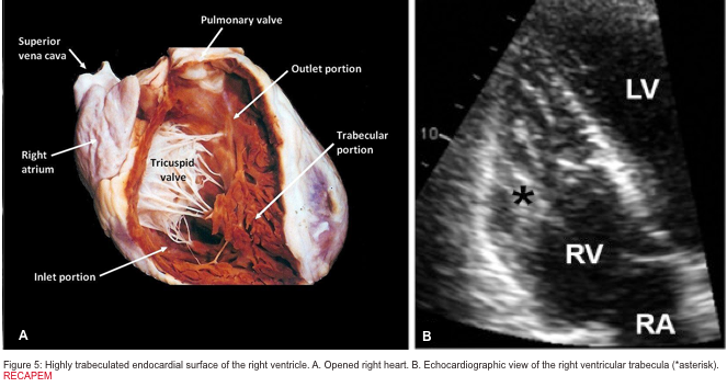 Acute Right Heart Failure: Principles of Diagnosis and Management In The ED  Revisited.