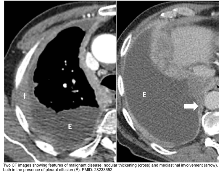 Pleural Effusion In Critically ill Patients RECAPEM