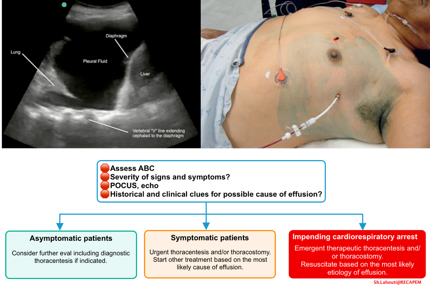 Pleural Effusion In Critically ill Patients