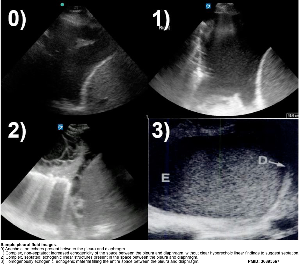 Pleural Effusion In Critically Ill Patients RECAPEM