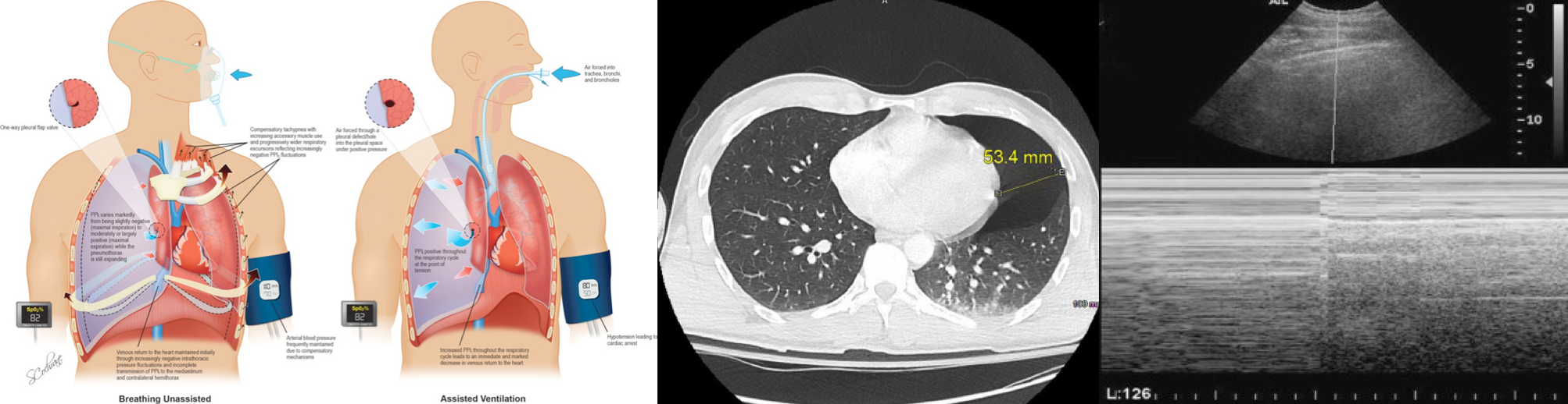 The Importance of Suction in Pulmonary Aspiration Emergencies