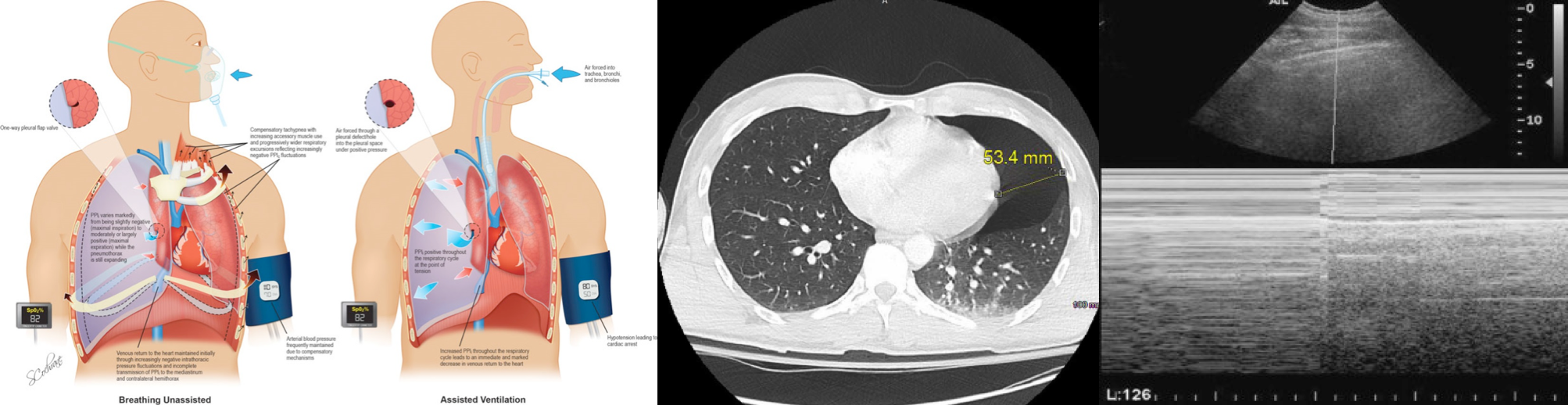 M-Mode for Pneumothorax  Emory School of Medicine