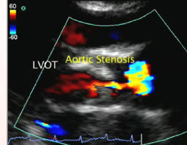 aortic stenosis