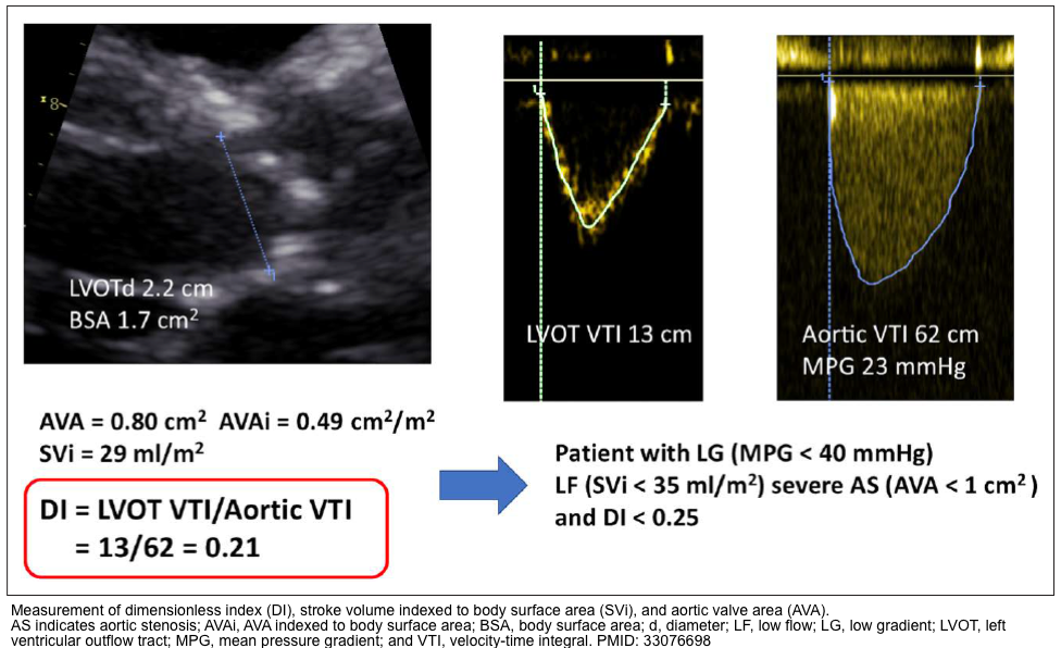 Valvular Emergencies: Diagnosis And Management Of Severe Aortic ...