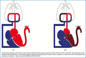 massive pulmonary embolism