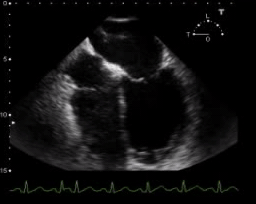 septic induced cardiomyopathy