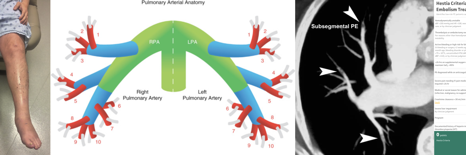 Diagnosing Pulmonary Embolism and Management of Low-Risk PE In ED