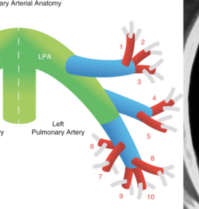 Diagnosing Pulmonary Embolism and Management of Low-Risk PE In ED