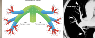 Diagnosing Pulmonary Embolism and Management of Low-Risk PE In ED