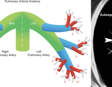 Diagnosing Pulmonary Embolism and Management of Low-Risk PE In ED